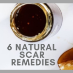 6 Natural Scar Remedies